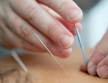 beneficios de la acupuntura en los ni�os