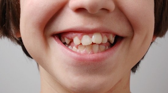 consecuencias de chuparse el dedo en ni�os m�s grandes